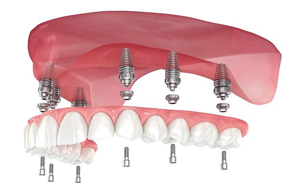 Maxillary,Prosthesis,With,Gum,All,On,6,System,Supported,By